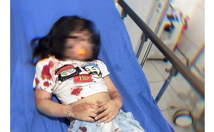 Bé gái 5 tuổi bị chó thả rông cắn trọng thương- Ảnh 1. Bé gái 5 tuổi bị chó thả rông cắn trọng thương- Ảnh 1.