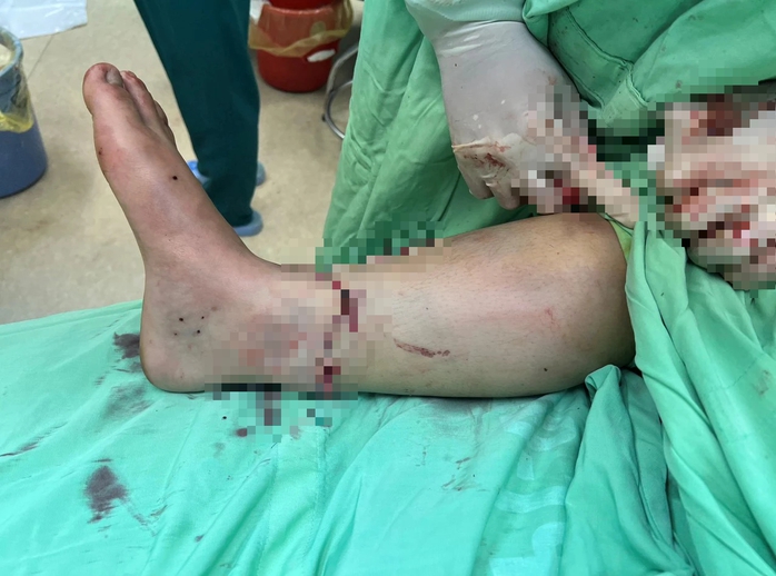 Nối liền đoạn chân đứt rời cho bệnh nhân bị tai nạn giao thông- Ảnh 1.