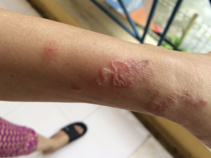 Nhiều người trẻ phải nhập viện do nhiễm giun đũa từ thú cưng- Ảnh 2. Nhiều người trẻ phải nhập viện do nhiễm giun đũa từ thú cưng- Ảnh 2.