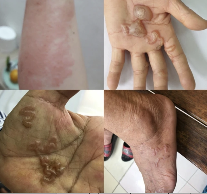 Nhiều người trẻ phải nhập viện do nhiễm giun đũa từ thú cưng- Ảnh 1. Nhiều người trẻ phải nhập viện do nhiễm giun đũa từ thú cưng- Ảnh 1.