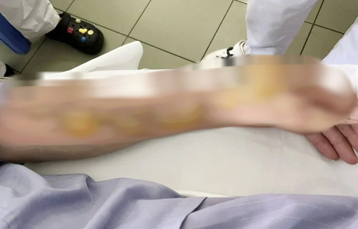 Hai người đàn ông bị bỏng nặng khi đốt rác- Ảnh 2. Hai người đàn ông bị bỏng nặng khi đốt rác- Ảnh 2.