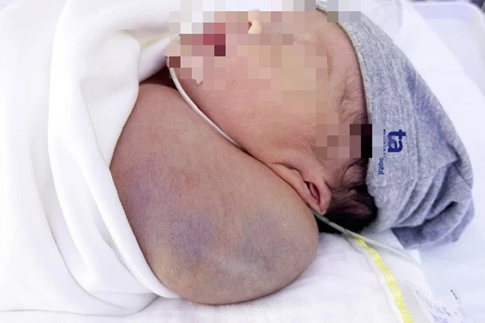 Bé trai mắc khối u nặng gần ⅓ cơ thể - Ảnh 1. Bé trai mắc khối u nặng gần ⅓ cơ thể - Ảnh 1.