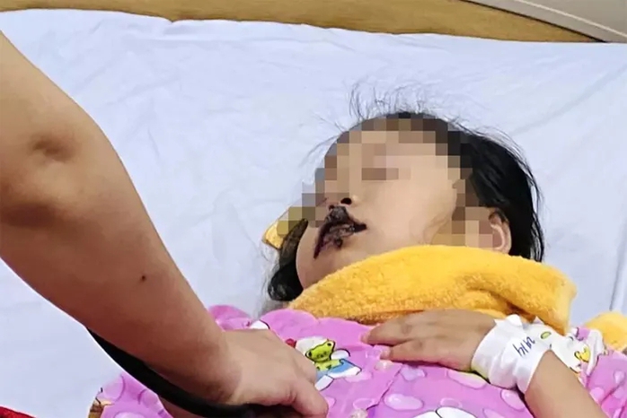 Nhầm tưởng là đường ăn, bé 5 tuổi nhập viện do nuốt xút ăn da- Ảnh 1. Nhầm tưởng là đường ăn, bé 5 tuổi nhập viện do nuốt xút ăn da- Ảnh 1.