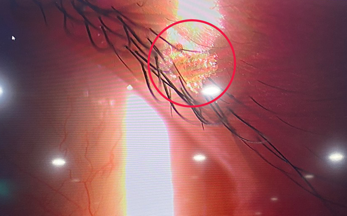 Bé gái 5 tuổi bị rận và trứng bám chi chít trên mi mắt- Ảnh 2. Bé gái 5 tuổi bị rận và trứng bám chi chít trên mi mắt- Ảnh 2.