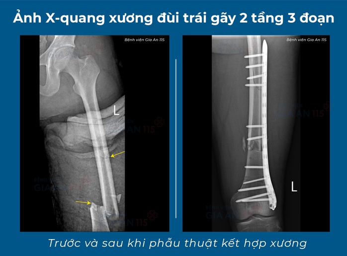 Mổ cùng lúc "3 trong 1" cứu ca tai nạn gãy xương nhiều đoạn- Ảnh 1. Mổ cùng lúc "3 trong 1" cứu ca tai nạn gãy xương nhiều đoạn- Ảnh 1.