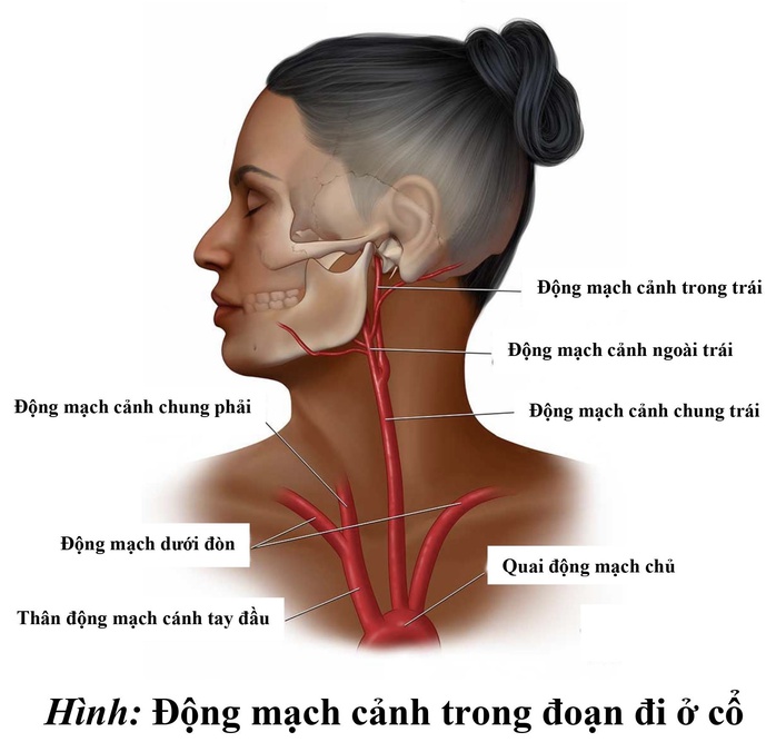 Người đàn ông đột quỵ sau khi giác hơi tại nhà- Ảnh 3. Người đàn ông đột quỵ sau khi giác hơi tại nhà- Ảnh 3.