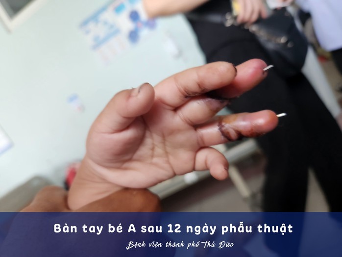 Nỗ lực cứu bàn tay bé trai bị máy quạt chém- Ảnh 2. Nỗ lực cứu bàn tay bé trai bị máy quạt chém- Ảnh 2.