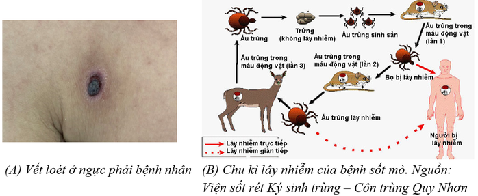 Nguy kịch do mò đốt- Ảnh 2. Nguy kịch do mò đốt- Ảnh 2.
