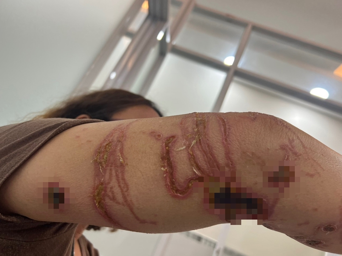 Hai người bị lở loét nặng sau khi đi tắm biển về- Ảnh 1. Hai người bị lở loét nặng sau khi đi tắm biển về- Ảnh 1.