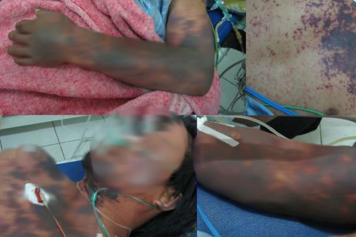 Đi cấp cứu sau vài ngày ăn món nhiều người Việt thích- Ảnh 2. Đi cấp cứu sau vài ngày ăn món nhiều người Việt thích- Ảnh 2.