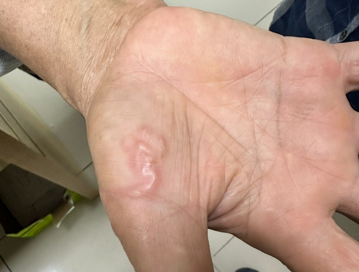 Nuôi 8 con chó mèo, người phụ nữ nhiễm giun đũa- Ảnh 1. Nuôi 8 con chó mèo, người phụ nữ nhiễm giun đũa- Ảnh 1.