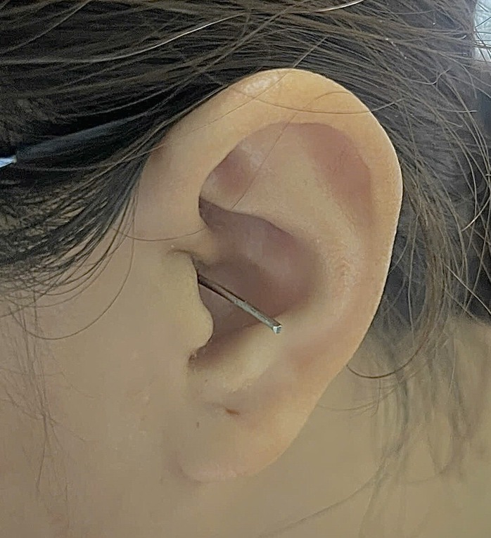 Đang lấy ráy tai, cô gái gặp nạn nghiêm trọng- Ảnh 1. Đang lấy ráy tai, cô gái gặp nạn nghiêm trọng- Ảnh 1.