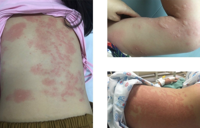 Cảnh giác triệu chứng nổi mề đay cấp ở trẻ- Ảnh 2. Cảnh giác triệu chứng nổi mề đay cấp ở trẻ- Ảnh 2.