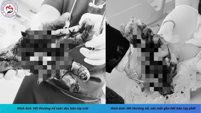 Nam thanh niên bị thương nặng, dập nát 2 bàn tay do đốt pháo tự chế- Ảnh 1. Nam thanh niên bị thương nặng, dập nát 2 bàn tay do đốt pháo tự chế- Ảnh 1.