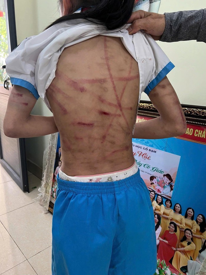 Vụ bé gái lớp 5 ở Hà Tĩnh bị bạo hành: Công an làm việc với cha dượng  - Ảnh 5.