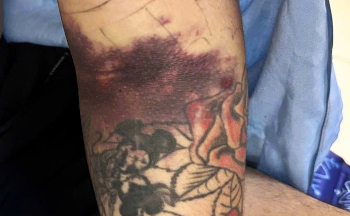 Biến chứng hiếm gặp ở nam thanh niên mắc sốt xuất huyết - Ảnh 1.