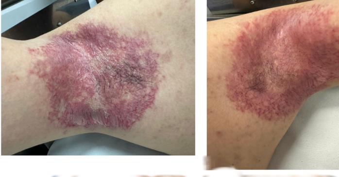 Bất ngờ từ ca bệnh da di truyền hiếm gặp đáp ứng botulinum toxin - Ảnh 1.