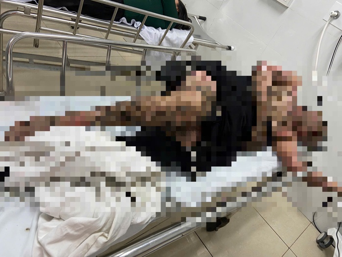 Bị điện giật bỏng nặng khi quăng cần câu vướng dây điện - Ảnh 1.