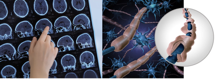 Căn bệnh khó nhận biết và điều trị ở người trẻ chỉ xuất hiện ở khí hậu lạnh đã được ghi nhận tại Việt Nam - Ảnh 1.