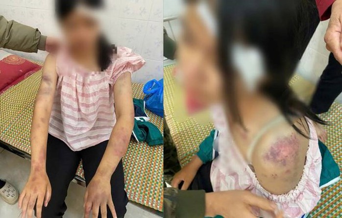 Bé gái 13 tuổi bị bà nội tra khảo, đánh đập dã man, người chi chít vết thương - Ảnh 1.