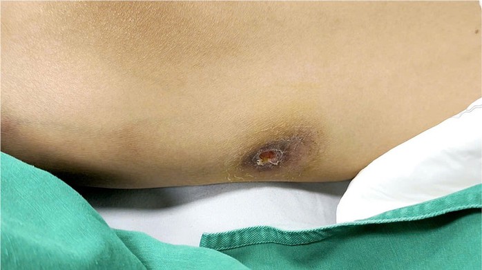 Nam thanh niên 39 tuổi ở Thanh Hóa bị bệnh Whitmore - Ảnh 2.