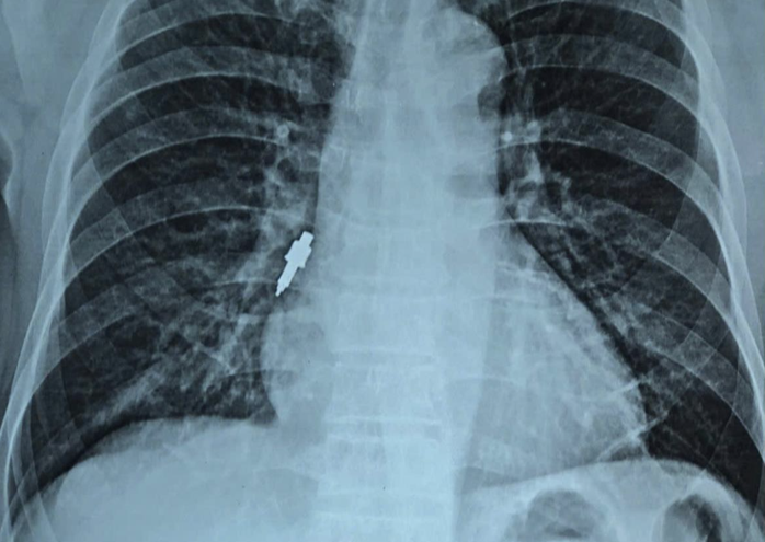 Dị vật kim loại mắc trong phế quản sau làm răng implant - Ảnh 1.