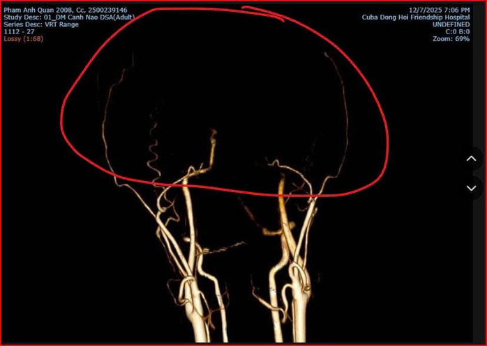 Bác sĩ bất ngờ lý giải nguyên nhân tử vong của thiếu niên xô xát ở quán bida Ba Đồn - Ảnh 1. Bác sĩ bất ngờ lý giải nguyên nhân tử vong của thiếu niên xô xát ở quán bida Ba Đồn - Ảnh 1.