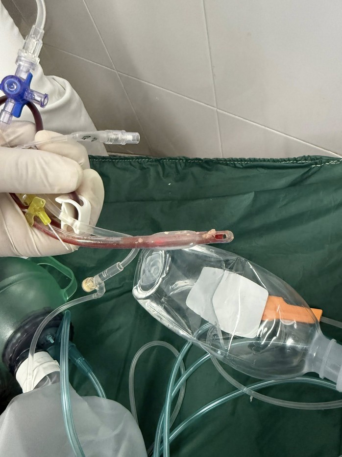 Lời cảnh báo từ bác sĩ cấp cứu sau vụ bé gái 3 tuổi tử vong vì sặc thức ăn tại nhà trẻ - Ảnh 1.