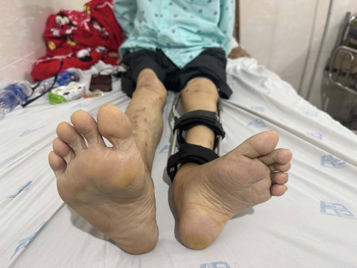 Thay khớp háng cho người đàn ông bị bại liệt hơn 55 năm - Ảnh 1.