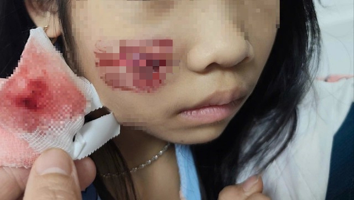 Khỉ hoang tấn công bé gái 7 tuổi ở Quảng Trị , nhập viện khẩn cấp - Ảnh 1. Khỉ hoang tấn công bé gái 7 tuổi ở Quảng Trị , nhập viện khẩn cấp - Ảnh 1.