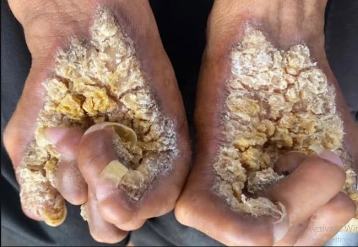 Người đàn ông mắc hội chứng “người cây”, chỉ có 2 người Việt Nam bị - Ảnh 1.