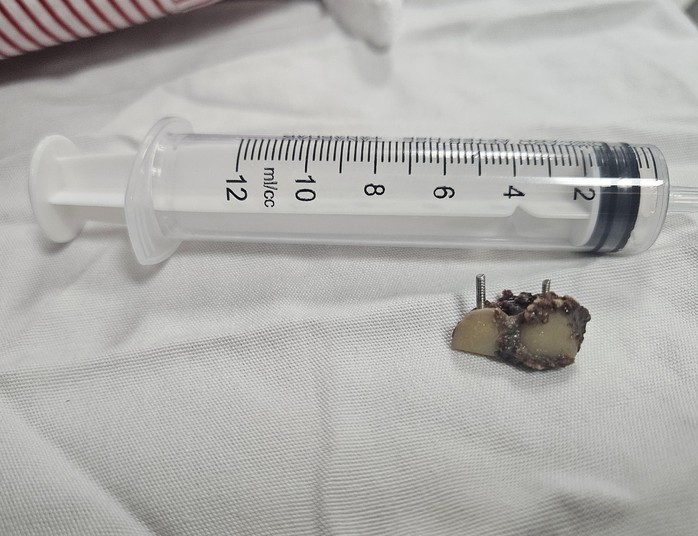 Người đ&agrave;n &ocirc;ng mang hai răng giả trong phổi suốt 20 năm - Ảnh 2.