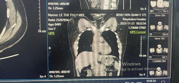 Ống th&ocirc;ng truyền h&oacute;a chất bị bỏ qu&ecirc;n, bị đứt rồi tr&ocirc;i v&agrave;o tim người phụ nữ - Ảnh 5.