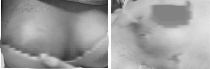 Cô gái trẻ nhập viện sau tiêm filler nâng ngực - Ảnh 1.