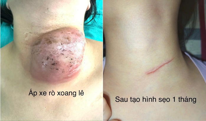 Phẫu thuật nội soi đóng rò xoang lê cho hàng chục trẻ em - Ảnh 1.