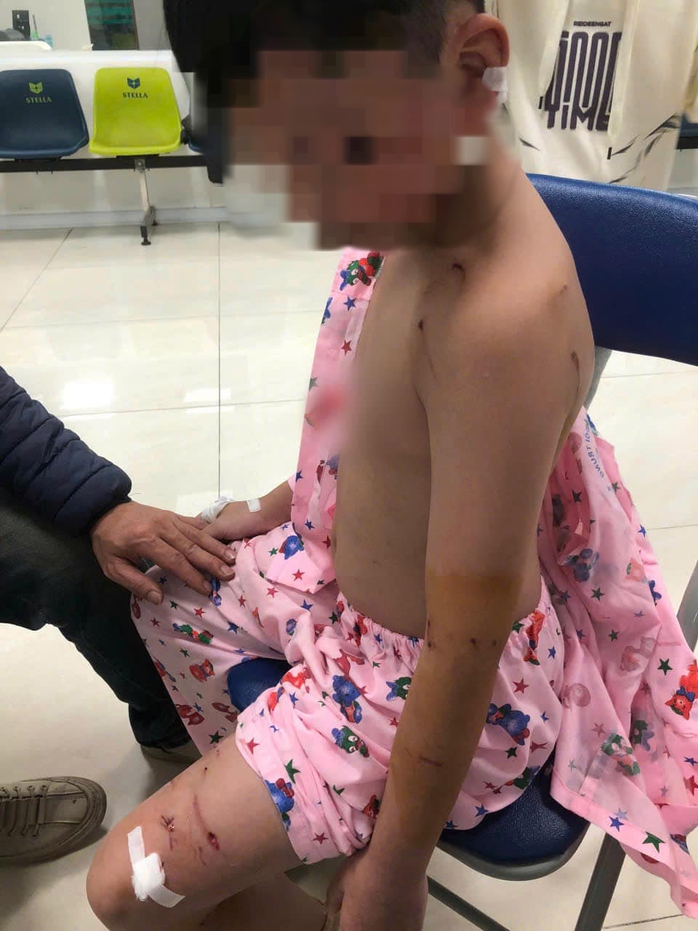 Bé trai bị chó cắn khi đi chúc Tết cùng gia đình- Ảnh 1. Bé trai bị chó cắn khi đi chúc Tết cùng gia đình- Ảnh 1.