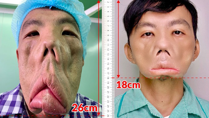 Anh Lê Văn Mến đã thoát khỏi gương mặt biến dạng đeo bám 15 năm Anh Lê Văn Mến đã thoát khỏi gương mặt biến dạng đeo bám 15 năm