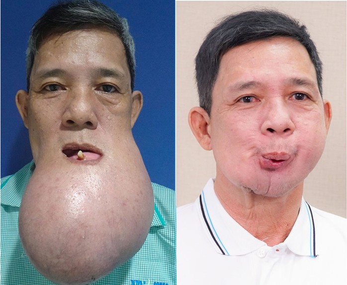 Ông Lê Quang Khanh tự tin hơn sau khi phẫu thuật cắt bỏ khối u 1 kg Ông Lê Quang Khanh tự tin hơn sau khi phẫu thuật cắt bỏ khối u 1 kg