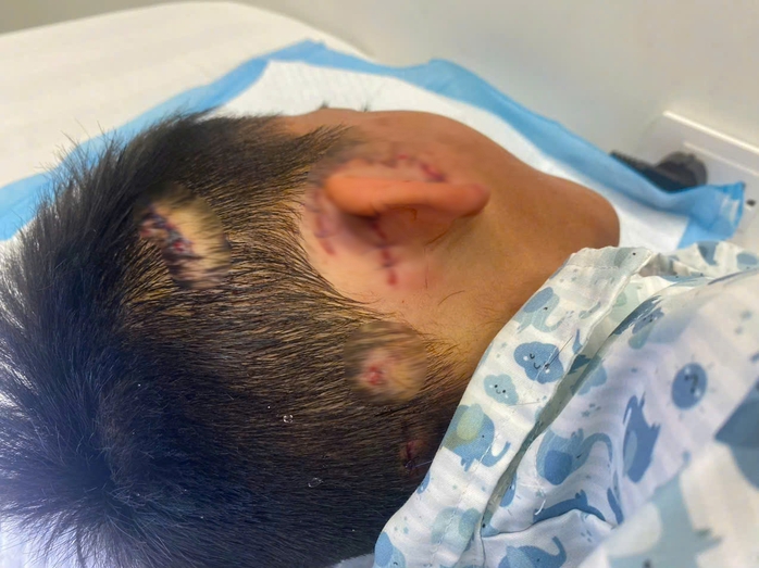 Bé trai bị chó cắn gần đứt rời vành tai- Ảnh 2.