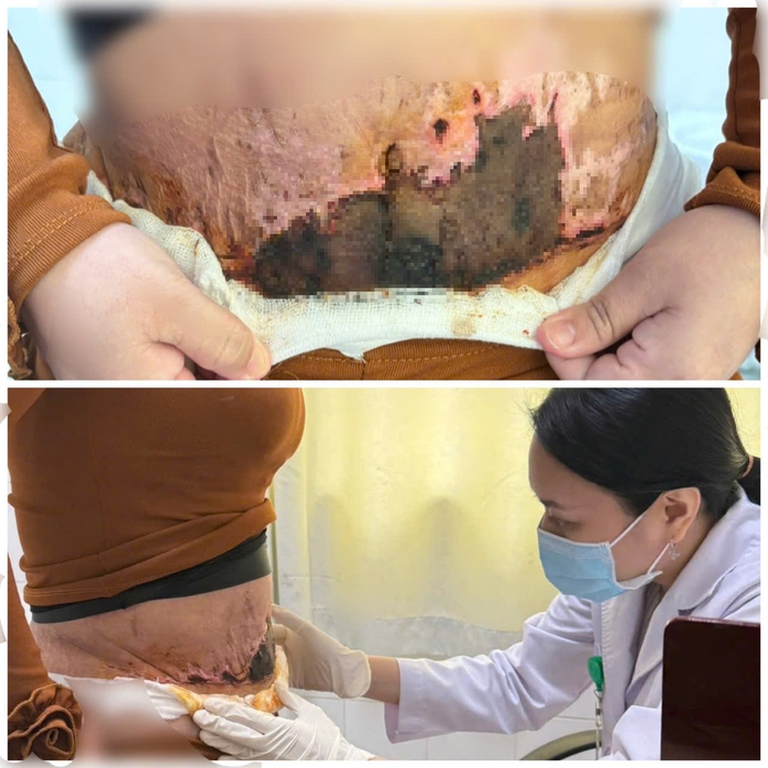Bị hoại tử da vì hút mỡ bụng tại cơ sở quảng cáo qua mạng- Ảnh 1. Bị hoại tử da vì hút mỡ bụng tại cơ sở quảng cáo qua mạng- Ảnh 1.