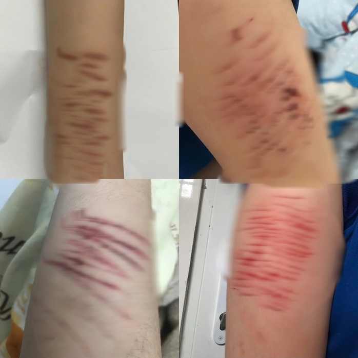 Bạn học phát hiện nữ sinh 15 tuổi vào nhà vệ sinh tự rạch tay- Ảnh 3. Bạn học phát hiện nữ sinh 15 tuổi vào nhà vệ sinh tự rạch tay- Ảnh 3.