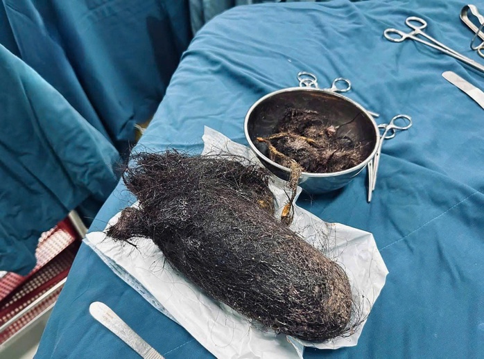 Bé gái 12 tuổi ăn búi tóc nặng gần 1 kg- Ảnh 1. Bé gái 12 tuổi ăn búi tóc nặng gần 1 kg- Ảnh 1.
