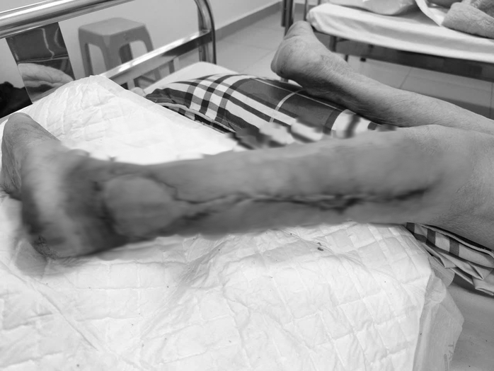 Bị chó cắn 1 năm, vết thương vẫn không liền- Ảnh 2. Bị chó cắn 1 năm, vết thương vẫn không liền- Ảnh 2.
