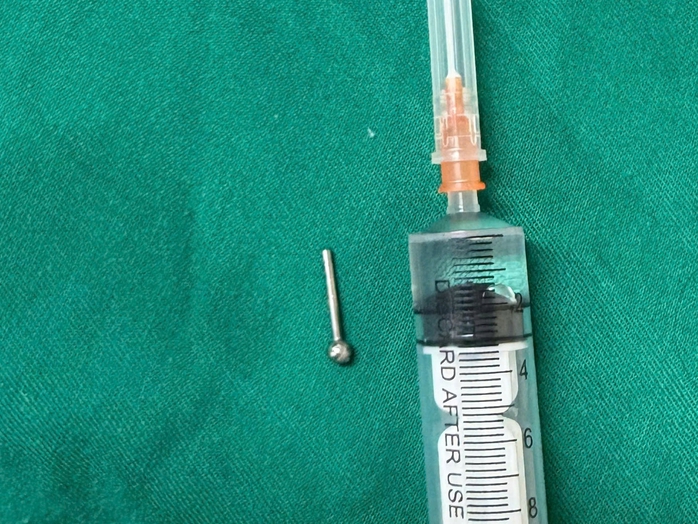 Cô gái 19 tuổi bị khuyên đeo ở lưỡi rơi vào dạ dày trong lúc ăn- Ảnh 1. Cô gái 19 tuổi bị khuyên đeo ở lưỡi rơi vào dạ dày trong lúc ăn- Ảnh 1.