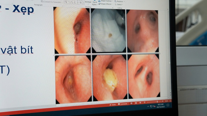 Cụ bà suýt mất mạng vì hóc khi ăn xoài- Ảnh 1. Cụ bà suýt mất mạng vì hóc khi ăn xoài- Ảnh 1.