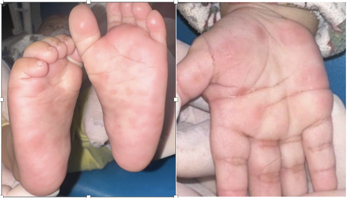 Bé trai 4 tháng tuổi mắc giang mai- Ảnh 1. Bé trai 4 tháng tuổi mắc giang mai- Ảnh 1.