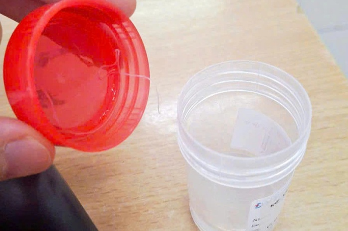 Sinh vật lạ dài gần 10 cm trong mắt người phụ nữ- Ảnh 1. Sinh vật lạ dài gần 10 cm trong mắt người phụ nữ- Ảnh 1.