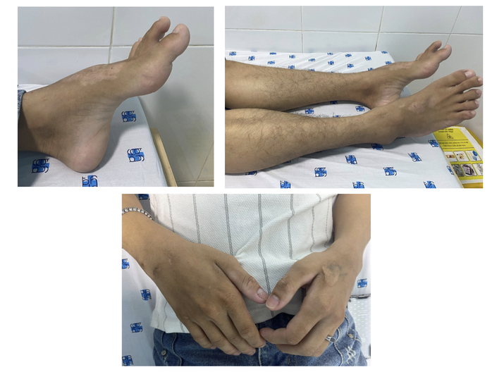 Phát hiện bệnh hiếm vì tê yếu tay chân kéo dài sau nhiều năm chẩn đoán nhầm - Ảnh 1.