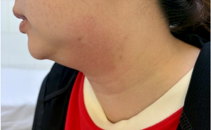 Người phụ nữ 33 tuổi ở miền Tây suýt trả giá đắt vì muốn tan mỡ - Ảnh 1. Người phụ nữ 33 tuổi ở miền Tây suýt trả giá đắt vì muốn tan mỡ - Ảnh 1.