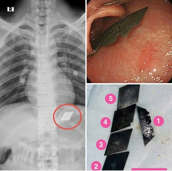 Hãi hùng một bệnh nhân "ngáo đá" ở TP HCM nuốt trọn bộ dao 5 món vào bụng- Ảnh 1. Hãi hùng một bệnh nhân "ngáo đá" ở TP HCM nuốt trọn bộ dao 5 món vào bụng- Ảnh 1.